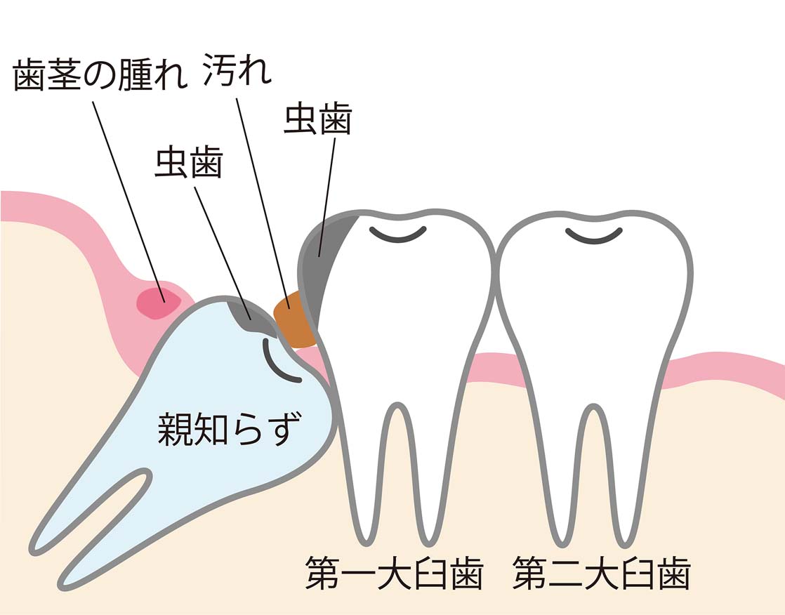 親知らずを抜いたほうがいいケース