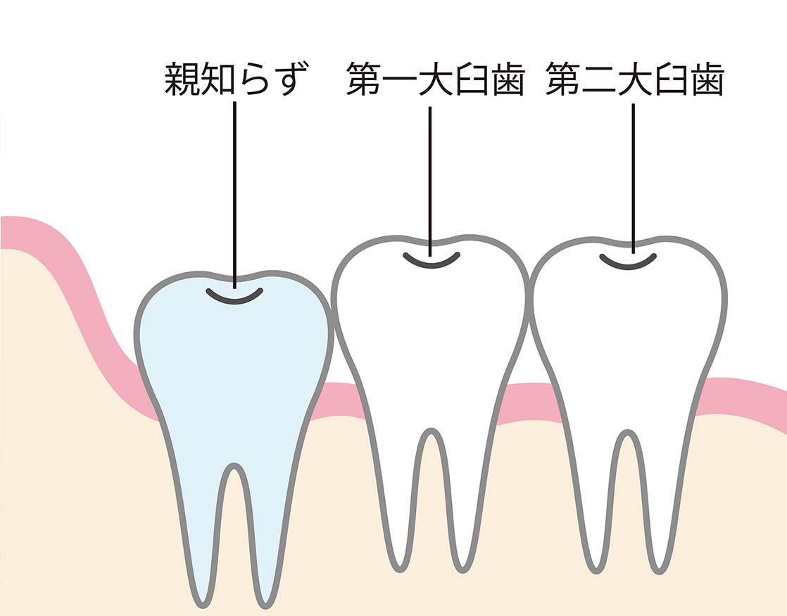 親知らず抜かなくてもいいケース