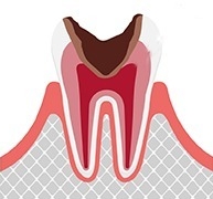 神経まで達した虫歯