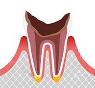 根だけ残った虫歯
